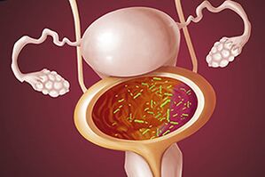 Βακτηριακή κυστίτιδα σε μια γυναίκα